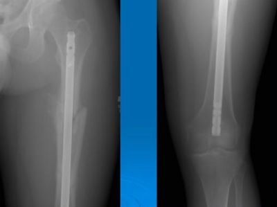 Trigen Knee Nail (Implant 85)